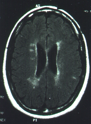 MRI of MS patient's brain