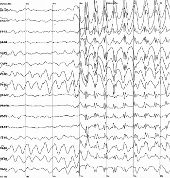 EEG showing a seizure